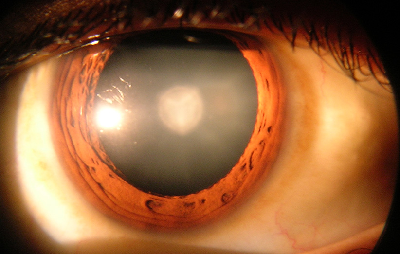  عدسی چشم انسان می‌تواند بعد از عمل آب مروارید دوباره رشد کند