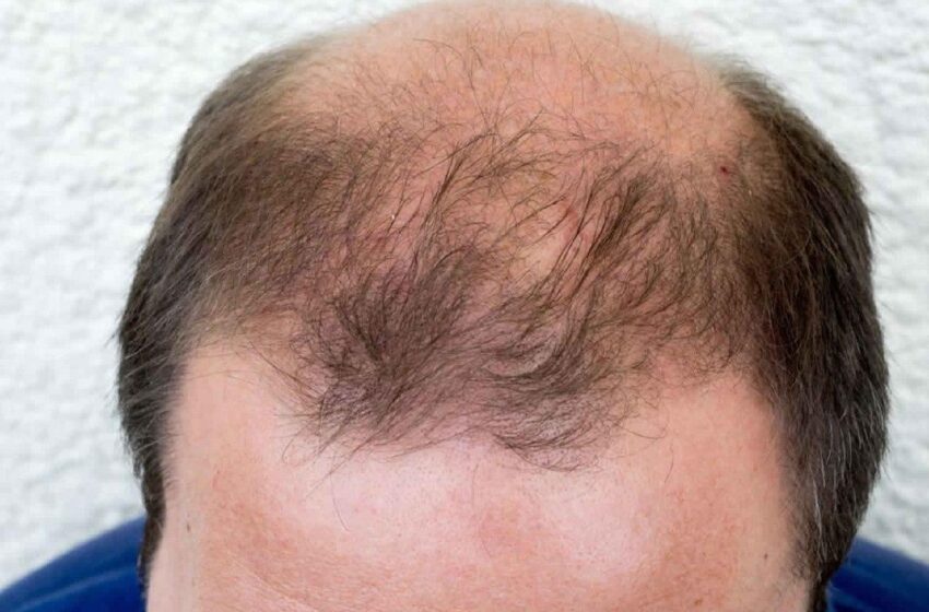  ژن‌های نادر عامل ریزش موی مردان شناسایی شدند