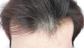  دلیل اصلی ریزش موی مردان و زنان