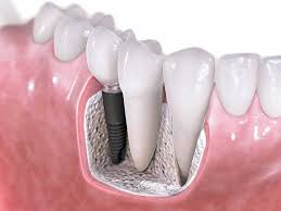  ایمپلنت دندان چیست؟ + آشنایی با انواع ایمپلنت