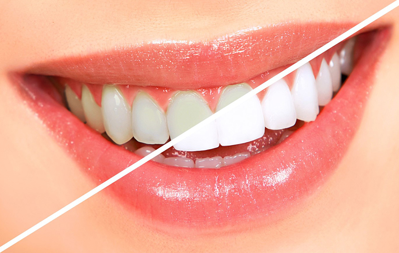  چرا دندان‌ها زرد می‌شوند؟ نکاتی برای پیشگیری و رفع زردی دندان
