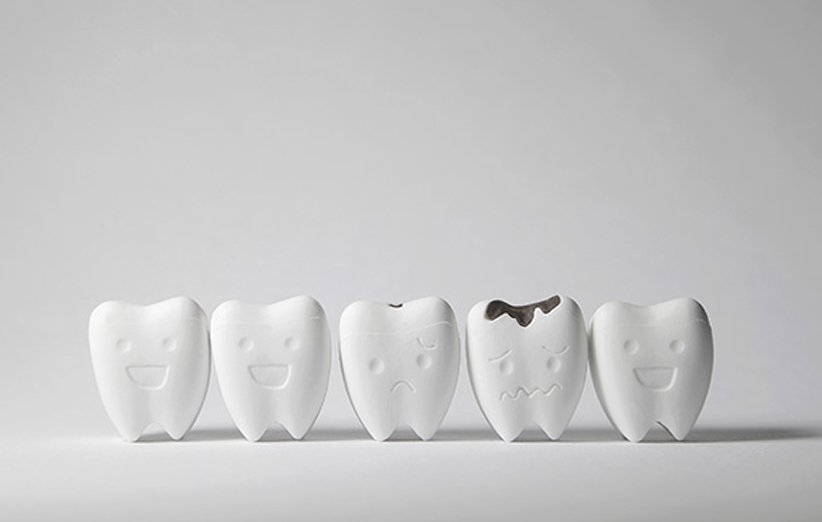  همه چیز درباره‌ی علت پوسیدگی دندان، راه‌های پیشگیری و درمان آن
