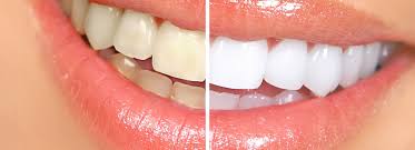  لاک سفید کننده دندان چیست؟ نحوه استفاده و مزایا و معایب