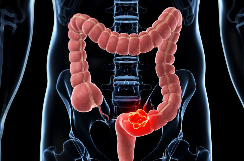  این علائم خطرناک است ؛ ۹ نشانه سرطان روده بزرگ