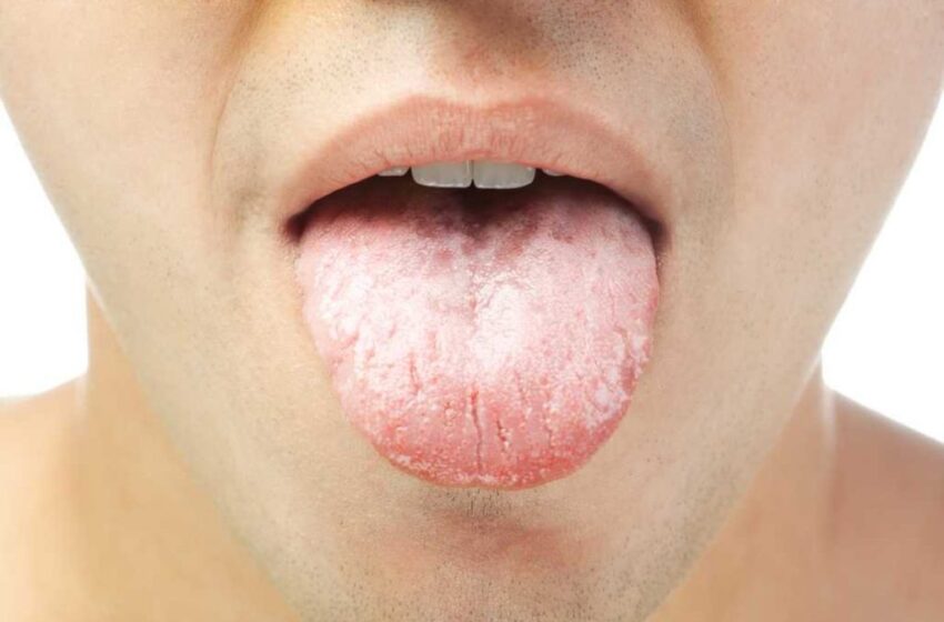  اگر دچار خشکی دهان هستید احتمالا به این بیماری ها مبتلا شده اید